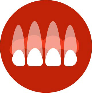 Loose or lost filling, crown or veneer